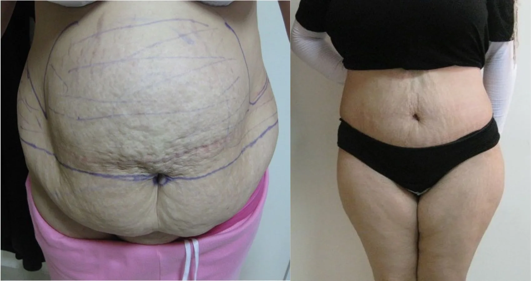 Avant et après : Abdominoplastie
