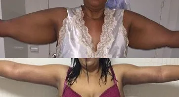 Avant et après : Lifting des bras