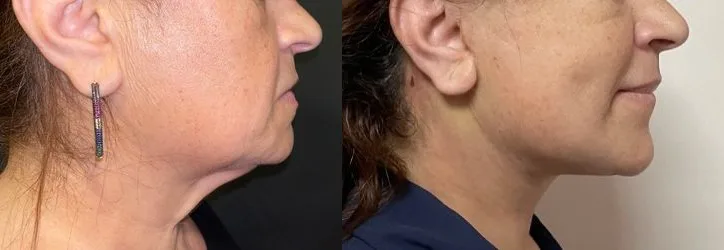 Avant et après : Lifting cervico-facial