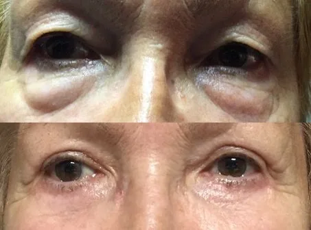 Avant et après : Blépharoplastie