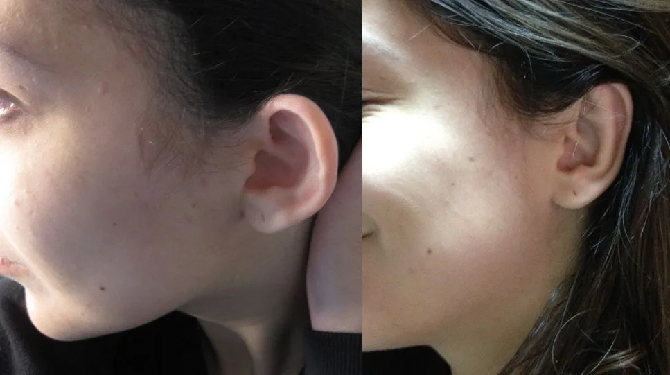 Avant et après : Otoplastie