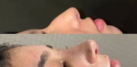 Avant et après : Rhinoplastie