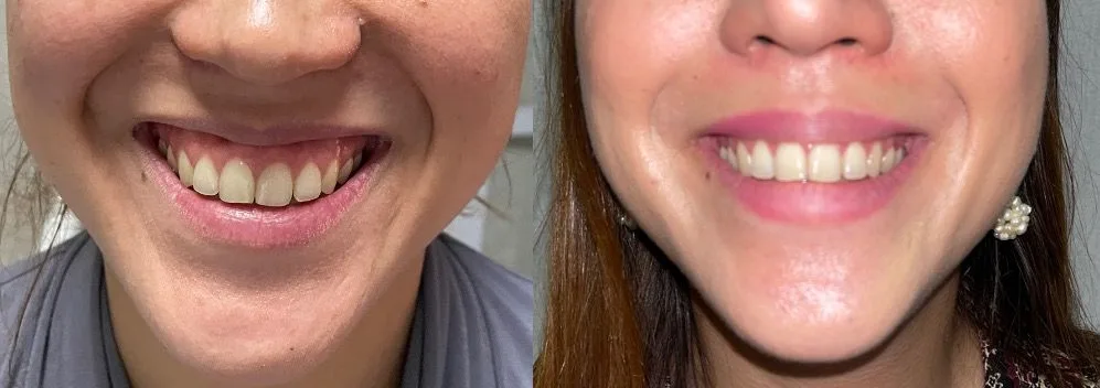 Avant et après : Sourire
